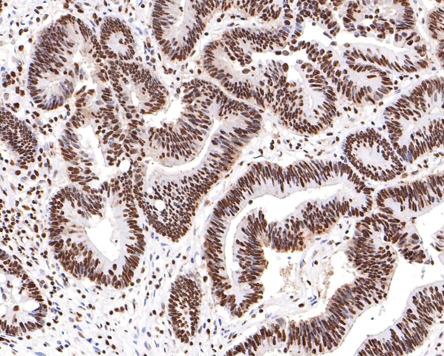 Immunohistochemical analysis of paraffin-embedded human colon carcinoma tissue with Rabbit anti-hnRNP U antibody (ET7107-10) at 1/200 dilution.<br />
<br />
The section was pre-treated using heat mediated antigen retrieval with sodium citrate buffer (pH 6.0) for 2 minutes. The tissues were blocked in 1% BSA for 20 minutes at room temperature, washed with ddH2O and PBS, and then probed with the primary antibody (ET7107-10) at 1/200 dilution for 1 hour at room temperature. The detection was performed using an HRP conjugated compact polymer system. DAB was used as the chromogen. Tissues were counterstained with hematoxylin and mounted with DPX.