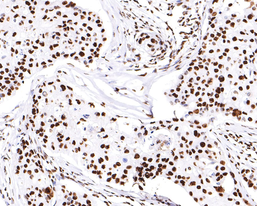 Immunohistochemical analysis of paraffin-embedded human breast carcinoma tissue with Rabbit anti-hnRNP U antibody (ET7107-10) at 1/200 dilution.<br />
<br />
The section was pre-treated using heat mediated antigen retrieval with sodium citrate buffer (pH 6.0) for 2 minutes. The tissues were blocked in 1% BSA for 20 minutes at room temperature, washed with ddH2O and PBS, and then probed with the primary antibody (ET7107-10) at 1/200 dilution for 1 hour at room temperature. The detection was performed using an HRP conjugated compact polymer system. DAB was used as the chromogen. Tissues were counterstained with hematoxylin and mounted with DPX.