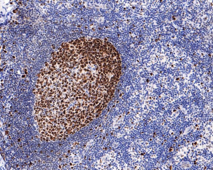Immunohistochemical analysis of paraffin-embedded human lymph nodes tissue with Rabbit anti-MCM5 antibody (ET7107-15) at 1/400 dilution.<br />
<br />
The section was pre-treated using heat mediated antigen retrieval with sodium citrate buffer (pH 6.0) for 2 minutes. The tissues were blocked in 1% BSA for 20 minutes at room temperature, washed with ddH2O and PBS, and then probed with the primary antibody (ET7107-15) at 1/400 dilution for 1 hour at room temperature. The detection was performed using an HRP conjugated compact polymer system. DAB was used as the chromogen. Tissues were counterstained with hematoxylin and mounted with DPX.