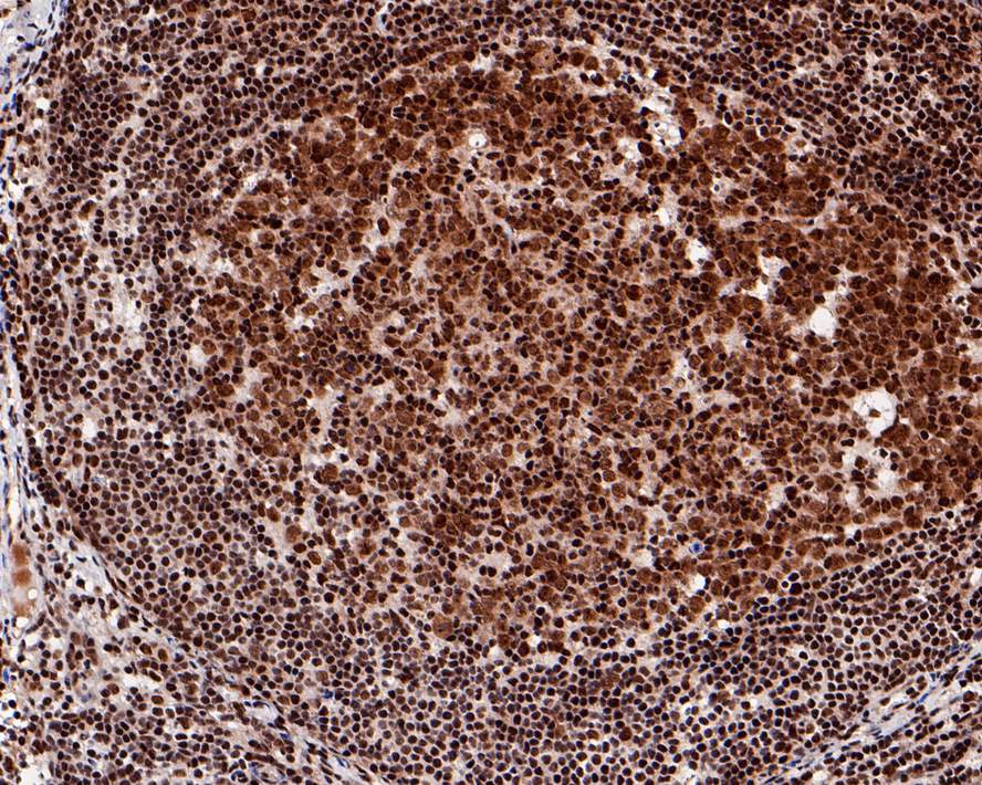 Immunohistochemical analysis of paraffin-embedded human lymph nodes tissue with Rabbit anti-eIF4A3 antibody (ET7108-11) at 1/800 dilution.<br />
<br />
The section was pre-treated using heat mediated antigen retrieval with sodium citrate buffer (pH 6.0) for 2 minutes. The tissues were blocked in 1% BSA for 20 minutes at room temperature, washed with ddH2O and PBS, and then probed with the primary antibody (ET7108-11) at 1/800 dilution for 1 hour at room temperature. The detection was performed using an HRP conjugated compact polymer system. DAB was used as the chromogen. Tissues were counterstained with hematoxylin and mounted with DPX.