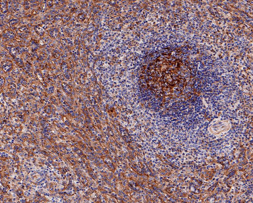 Immunohistochemical analysis of paraffin-embedded human lymph nodes tissue with Rabbit anti-CD14 antibody (ET1610-85) at 1/800 dilution.<br />
<br />
The section was pre-treated using heat mediated antigen retrieval with Tris-EDTA buffer (pH 9.0) for 20 minutes. The tissues were blocked in 1% BSA for 20 minutes at room temperature, washed with ddH2O and PBS, and then probed with the primary antibody (ET1610-85) at 1/800 dilution for 1 hour at room temperature. The detection was performed using an HRP conjugated compact polymer system. DAB was used as the chromogen. Tissues were counterstained with hematoxylin and mounted with DPX.