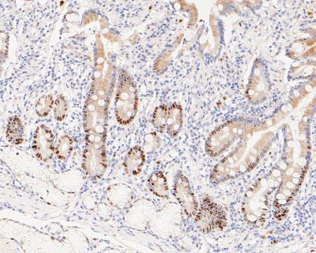 Immunohistochemical analysis of paraffin-embedded human colon carcinoma tissue using anti-Cyclin D1 antibody. The section was pre-treated using heat mediated antigen retrieval with sodium citrate buffer (pH 6.0) for 2 minutes. The tissues were blocked in 5% BSA for 30 minutes at room temperature, washed with ddH2O and PBS, and then probed with the primary antibody (ET1601-31, 1/200)  for 30 minutes at room temperature. The detection was performed using an HRP conjugated compact polymer system. DAB was used as the chromogen. Tissues were counterstained with hematoxylin and mounted with DPX.