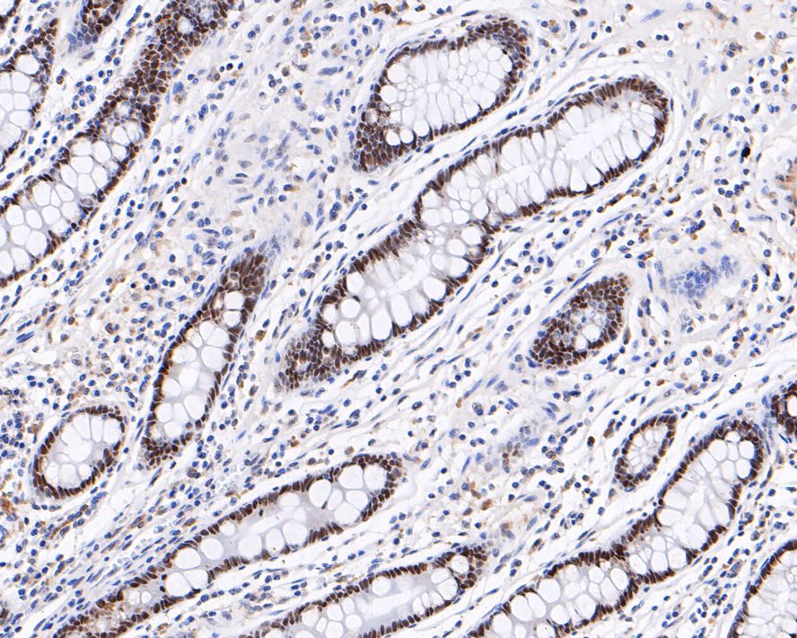 Immunohistochemical analysis of paraffin-embedded human small intestine tissue with Rabbit anti-HNF-4-alpha antibody (ET1611-43) at 1/200 dilution.<br />
<br />
The section was pre-treated using heat mediated antigen retrieval with sodium citrate buffer (pH 6.0) for 2 minutes. The tissues were blocked in 1% BSA for 20 minutes at room temperature, washed with ddH2O and PBS, and then probed with the primary antibody (ET1611-43) at 1/200 dilution for 1 hour at room temperature. The detection was performed using an HRP conjugated compact polymer system. DAB was used as the chromogen. Tissues were counterstained with hematoxylin and mounted with DPX.