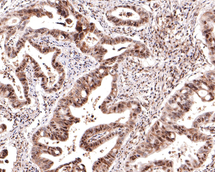Immunohistochemical analysis of paraffin-embedded human colon carcinoma tissue with Rabbit anti-Caspase-9 antibody (ET1603-27) at 1/400 dilution.<br />
<br />
The section was pre-treated using heat mediated antigen retrieval with sodium citrate buffer (pH 6.0) for 2 minutes. The tissues were blocked in 1% BSA for 20 minutes at room temperature, washed with ddH2O and PBS, and then probed with the primary antibody (ET1603-27) at 1/400 dilution for 1 hour at room temperature. The detection was performed using an HRP conjugated compact polymer system. DAB was used as the chromogen. Tissues were counterstained with hematoxylin and mounted with DPX.