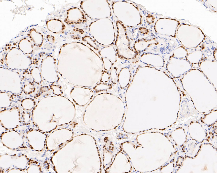 Immunohistochemical analysis of paraffin-embedded human thyroid tissue with Rabbit anti-SOX9 antibody (ET1611-56) at 1/50 dilution.<br />
<br />
The section was pre-treated using heat mediated antigen retrieval with sodium citrate buffer (pH 6.0) for 2 minutes. The tissues were blocked in 1% BSA for 20 minutes at room temperature, washed with ddH2O and PBS, and then probed with the primary antibody (ET1611-56) at 1/50 dilution for 1 hour at room temperature. The detection was performed using an HRP conjugated compact polymer system. DAB was used as the chromogen. Tissues were counterstained with hematoxylin and mounted with DPX.