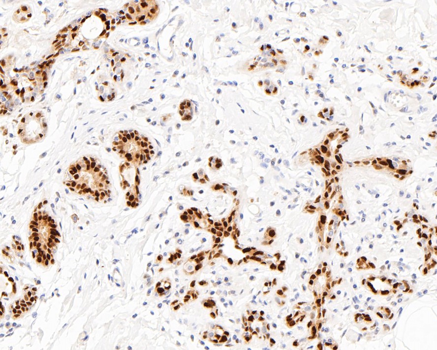 Immunohistochemical analysis of paraffin-embedded human breast tissue with Rabbit anti-SOX9 antibody (ET1611-56) at 1/50 dilution.<br />
<br />
The section was pre-treated using heat mediated antigen retrieval with sodium citrate buffer (pH 6.0) for 2 minutes. The tissues were blocked in 1% BSA for 20 minutes at room temperature, washed with ddH2O and PBS, and then probed with the primary antibody (ET1611-56) at 1/50 dilution for 1 hour at room temperature. The detection was performed using an HRP conjugated compact polymer system. DAB was used as the chromogen. Tissues were counterstained with hematoxylin and mounted with DPX.