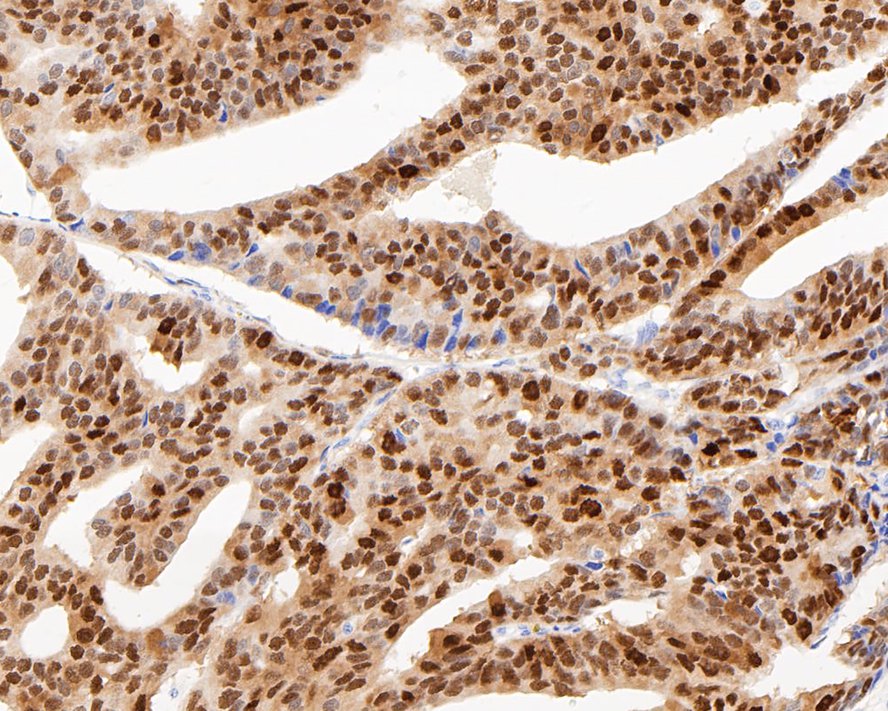Immunohistochemical analysis of paraffin-embedded human prostate carcinoma tissue with Rabbit anti-SOX9 antibody (ET1611-56) at 1/200 dilution.<br />
<br />
The section was pre-treated using heat mediated antigen retrieval with sodium citrate buffer (pH 6.0) for 2 minutes. The tissues were blocked in 1% BSA for 20 minutes at room temperature, washed with ddH2O and PBS, and then probed with the primary antibody (ET1611-56) at 1/200 dilution for 1 hour at room temperature. The detection was performed using an HRP conjugated compact polymer system. DAB was used as the chromogen. Tissues were counterstained with hematoxylin and mounted with DPX.