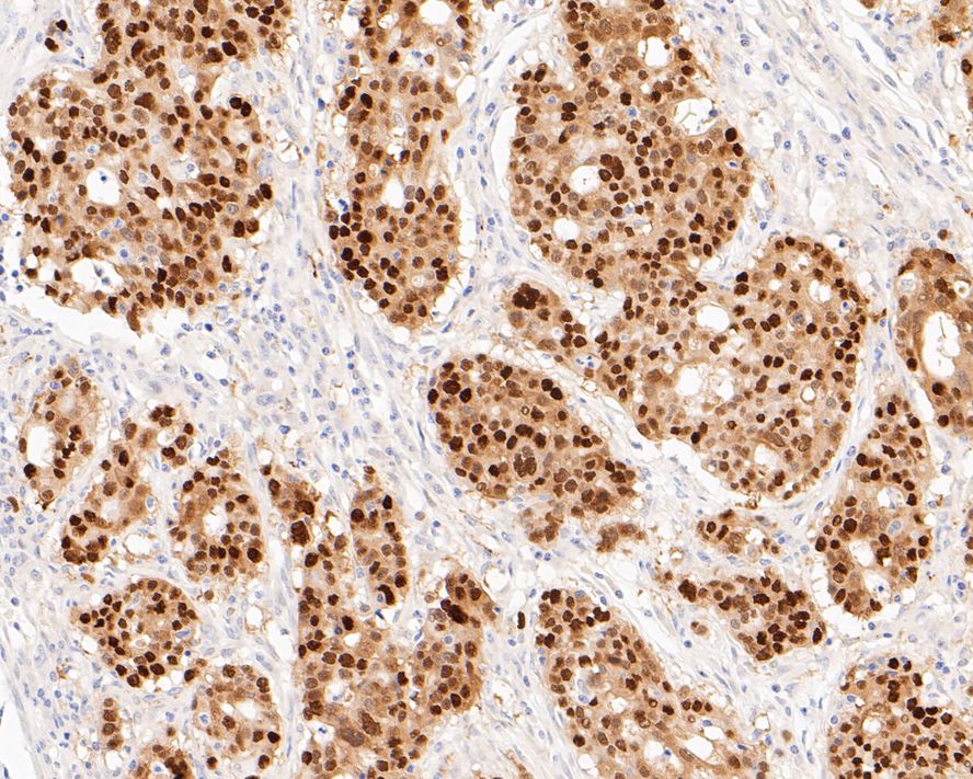 Immunohistochemical analysis of paraffin-embedded human stomach carcinoma tissue with Rabbit anti-SOX9 antibody (ET1611-56) at 1/50 dilution.<br />
<br />
The section was pre-treated using heat mediated antigen retrieval with sodium citrate buffer (pH 6.0) for 2 minutes. The tissues were blocked in 1% BSA for 20 minutes at room temperature, washed with ddH2O and PBS, and then probed with the primary antibody (ET1611-56) at 1/50 dilution for 1 hour at room temperature. The detection was performed using an HRP conjugated compact polymer system. DAB was used as the chromogen. Tissues were counterstained with hematoxylin and mounted with DPX.