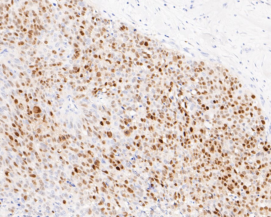 Immunohistochemical analysis of paraffin-embedded human lung carcinoma tissue with Rabbit anti-SOX9 antibody (ET1611-56) at 1/200 dilution.<br />
<br />
The section was pre-treated using heat mediated antigen retrieval with sodium citrate buffer (pH 6.0) for 2 minutes. The tissues were blocked in 1% BSA for 20 minutes at room temperature, washed with ddH2O and PBS, and then probed with the primary antibody (ET1611-56) at 1/200 dilution for 1 hour at room temperature. The detection was performed using an HRP conjugated compact polymer system. DAB was used as the chromogen. Tissues were counterstained with hematoxylin and mounted with DPX.