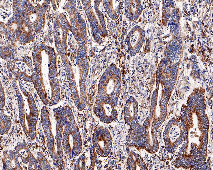 Immunohistochemical analysis of paraffin-embedded human colon carcinoma tissue with Rabbit anti-CPT2 antibody (ET1611-64) at 1/1,000 dilution.<br />
<br />
The section was pre-treated using heat mediated antigen retrieval with Tris-EDTA buffer (pH 9.0) for 20 minutes. The tissues were blocked in 1% BSA for 20 minutes at room temperature, washed with ddH2O and PBS, and then probed with the primary antibody (ET1611-64) at 1/1,000 dilution for 1 hour at room temperature. The detection was performed using an HRP conjugated compact polymer system. DAB was used as the chromogen. Tissues were counterstained with hematoxylin and mounted with DPX.