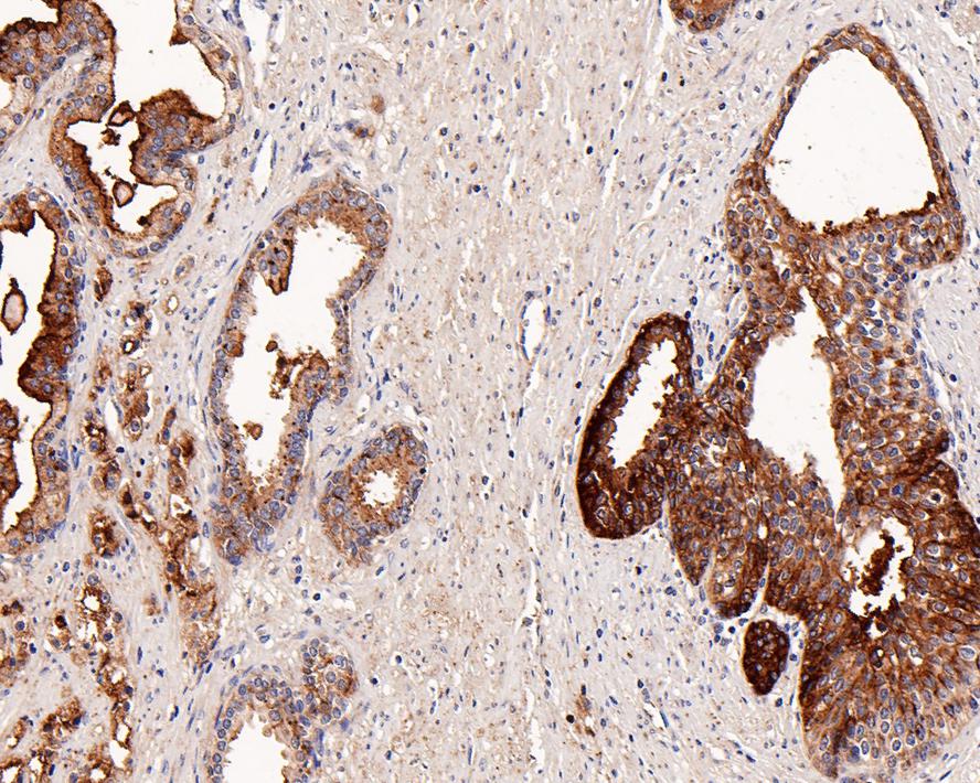 Immunohistochemical analysis of paraffin-embedded human prostate carcinoma tissue with Rabbit anti-CD10 antibody (ET1611-82) at 1/1,000 dilution.<br />
<br />
The section was pre-treated using heat mediated antigen retrieval with Tris-EDTA buffer (pH 9.0) for 20 minutes. The tissues were blocked in 1% BSA for 20 minutes at room temperature, washed with ddH2O and PBS, and then probed with the primary antibody (ET1611-82) at 1/1,000 dilution for 1 hour at room temperature. The detection was performed using an HRP conjugated compact polymer system. DAB was used as the chromogen. Tissues were counterstained with hematoxylin and mounted with DPX.