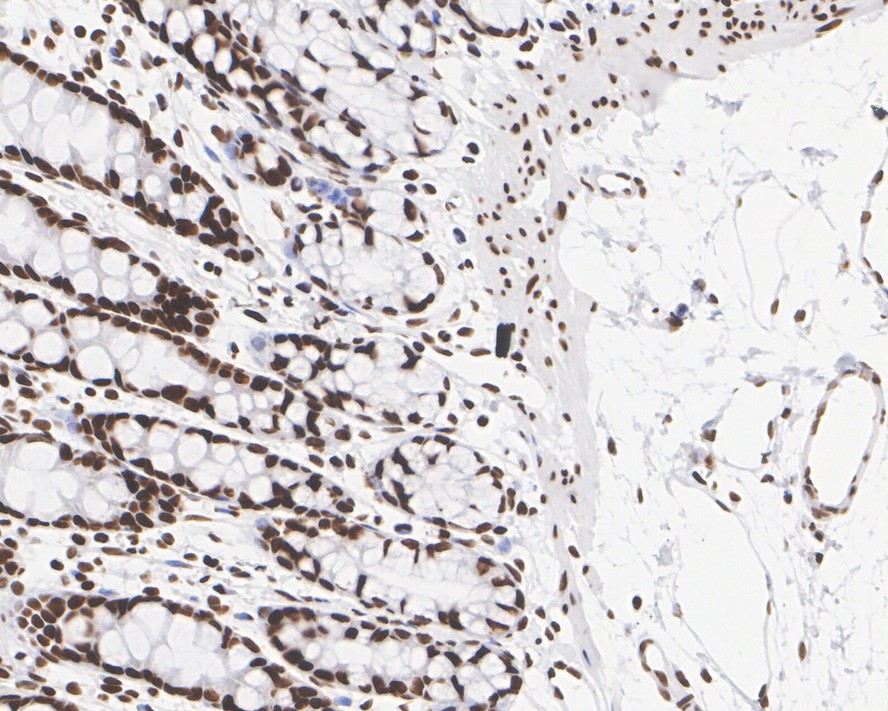 Immunohistochemical analysis of paraffin-embedded mouse epididymis tissue with Rabbit anti-BRG1 antibody (ET1611-85) at 1/500 dilution.<br />
<br />
The section was pre-treated using heat mediated antigen retrieval with sodium citrate buffer (pH 6.0) for 2 minutes. The tissues were blocked in 1% BSA for 20 minutes at room temperature, washed with ddH2O and PBS, and then probed with the primary antibody (ET1611-85) at 1/500 dilution for 1 hour at room temperature. The detection was performed using an HRP conjugated compact polymer system. DAB was used as the chromogen. Tissues were counterstained with hematoxylin and mounted with DPX.