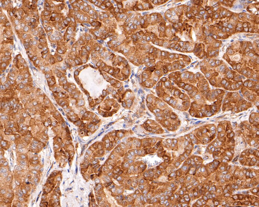 Immunohistochemical analysis of paraffin-embedded human thyroid carcinoma tissue with Rabbit anti-Cdk5 antibody (ET1602-17) at 1/400 dilution.<br />
<br />
The section was pre-treated using heat mediated antigen retrieval with sodium citrate buffer (pH 6.0) for 2 minutes. The tissues were blocked in 1% BSA for 20 minutes at room temperature, washed with ddH2O and PBS, and then probed with the primary antibody (ET1602-17) at 1/400 dilution for 1 hour at room temperature. The detection was performed using an HRP conjugated compact polymer system. DAB was used as the chromogen. Tissues were counterstained with hematoxylin and mounted with DPX.