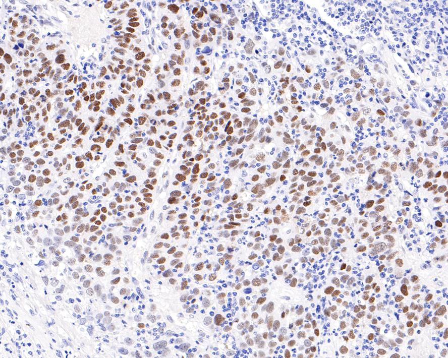Immunohistochemical analysis of paraffin-embedded human stomach carcinoma tissue with Rabbit anti-G9a antibody (ET7110-08) at 1/400 dilution.<br />
<br />
The section was pre-treated using heat mediated antigen retrieval with sodium citrate buffer (pH 6.0) for 2 minutes. The tissues were blocked in 1% BSA for 20 minutes at room temperature, washed with ddH2O and PBS, and then probed with the primary antibody (ET7110-08) at 1/400 dilution for 1 hour at room temperature. The detection was performed using an HRP conjugated compact polymer system. DAB was used as the chromogen. Tissues were counterstained with hematoxylin and mounted with DPX.