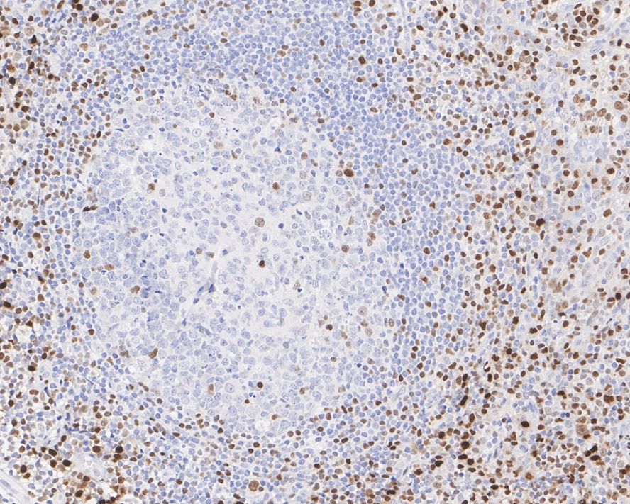 Immunohistochemical analysis of paraffin-embedded human colon tissue with Rabbit anti-RUNX2 antibody (ET1612-47) at 1/500 dilution.<br />
<br />
The section was pre-treated using heat mediated antigen retrieval with sodium citrate buffer (pH 6.0) for 2 minutes. The tissues were blocked in 1% BSA for 20 minutes at room temperature, washed with ddH2O and PBS, and then probed with the primary antibody (ET1612-47) at 1/500 dilution for 1 hour at room temperature. The detection was performed using an HRP conjugated compact polymer system. DAB was used as the chromogen. Tissues were counterstained with hematoxylin and mounted with DPX.
