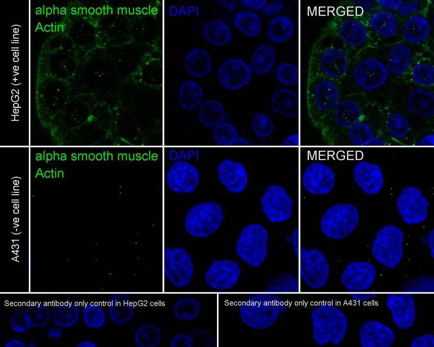 Immunofluorescence analysis of paraffin-embedded human stomach cancer tissue labeling alpha smooth muscle Actin (ET1607-53) and ALDH2 (M1509-1).<br />
<br />
The section was pre-treated using heat mediated antigen retrieval with Tris-EDTA buffer (pH 9.0) for 20 minutes. The tissues were blocked in 10% negative goat serum for 1 hour at room temperature, washed with PBS. And then probed with the primary antibody alpha smooth muscle Actin (ET1607-53, red) at 1/1,000 dilution and ALDH2 (M1509-1, green) at 1/100 dilution overnight at 4 ℃, washed with PBS.<br />
<br />
iFluor™ 488 conjugate-Goat anti-Mouse IgG (HA1125) and iFluor™ 647 conjugate-Goat anti-Rabbit IgG (HA1123) was used as the secondary antibody at 1/1,000 dilution. DAPI was used as nuclear counterstain.