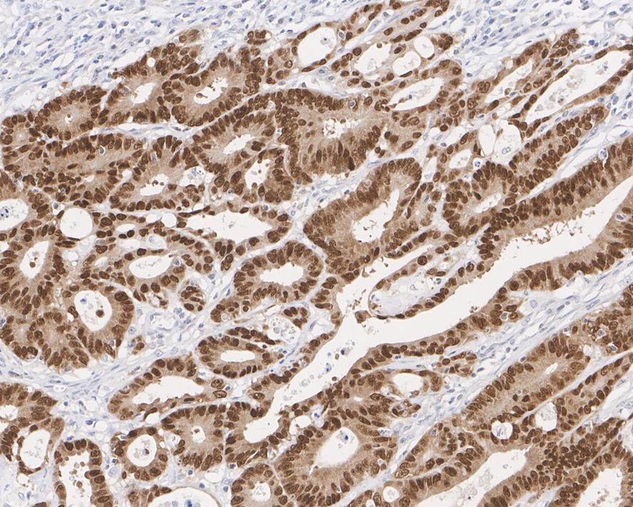 Immunohistochemical analysis of paraffin-embedded human appendix tissue with Rabbit anti-CDX2 antibody (ET1605-4) at 1/200 dilution.<br />
<br />
The section was pre-treated using heat mediated antigen retrieval with sodium citrate buffer (pH 6.0) for 2 minutes. The tissues were blocked in 1% BSA for 20 minutes at room temperature, washed with ddH2O and PBS, and then probed with the primary antibody (ET1605-4) at 1/200 dilution for 1 hour at room temperature. The detection was performed using an HRP conjugated compact polymer system. DAB was used as the chromogen. Tissues were counterstained with hematoxylin and mounted with DPX.