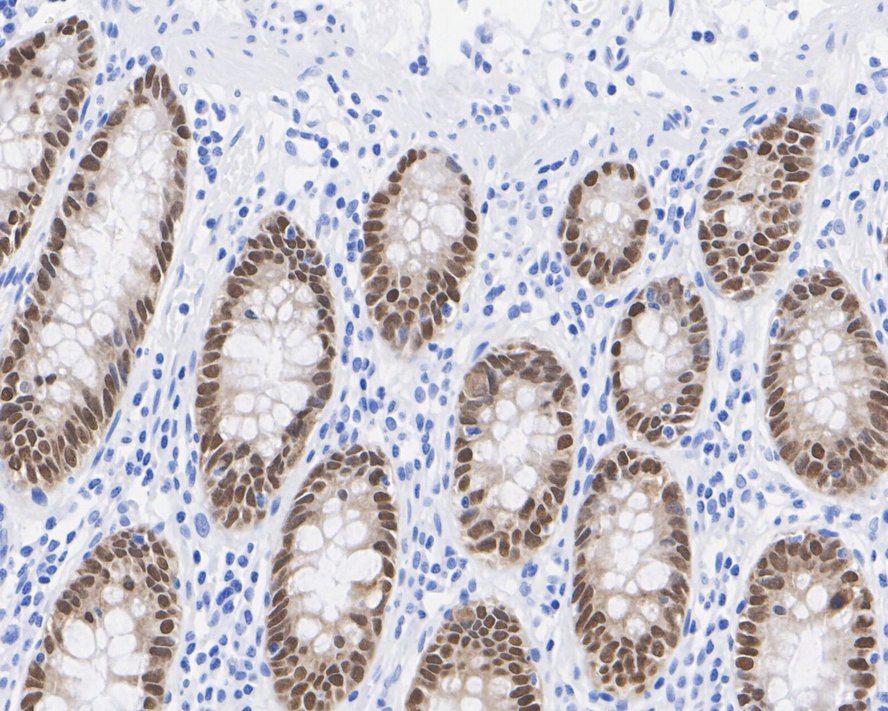 Immunohistochemical analysis of paraffin-embedded Human stomach cancer tissue with Rabbit anti-CDX2 antibody (ET1605-4) at 1/200 dilution.<br />
<br />
The section was pre-treated using heat mediated antigen retrieval with sodium citrate buffer (pH 6.0) for 2 minutes. The tissues were blocked in 1% BSA for 20 minutes at room temperature, washed with ddH2O and PBS, and then probed with the primary antibody (ET1605-4) at 1/200 dilution for 1 hour at room temperature. The detection was performed using an HRP conjugated compact polymer system. DAB was used as the chromogen. Tissues were counterstained with hematoxylin and mounted with DPX.