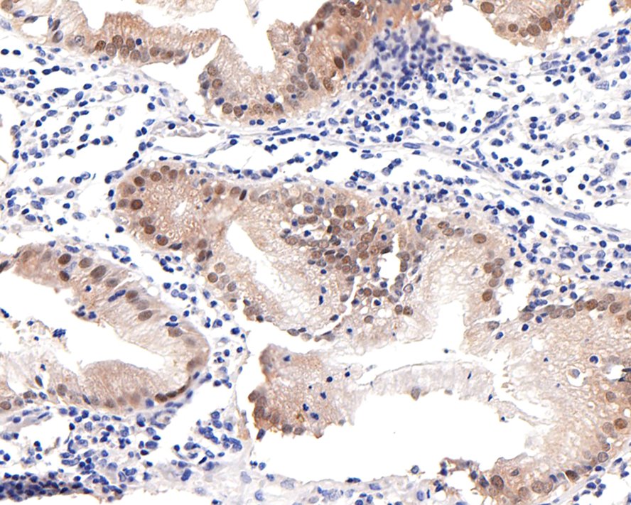 Immunohistochemical analysis of paraffin-embedded human gallbladder tissue with Rabbit anti-PDX1 antibody (ET1705-99) at 1/100 dilution.<br />
<br />
The section was pre-treated using heat mediated antigen retrieval with sodium citrate buffer (pH 6.0) for 2 minutes. The tissues were blocked in 1% BSA for 20 minutes at room temperature, washed with ddH2O and PBS, and then probed with the primary antibody (ET1705-99) at 1/100 dilution for 1 hour at room temperature. The detection was performed using an HRP conjugated compact polymer system. DAB was used as the chromogen. Tissues were counterstained with hematoxylin and mounted with DPX.