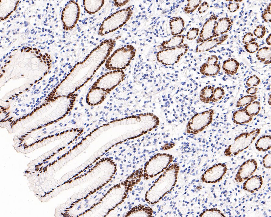 Immunohistochemical analysis of paraffin-embedded human stomach tissue with Rabbit anti-PDX1 antibody (ET1705-99) at 1/800 dilution.<br />
<br />
The section was pre-treated using heat mediated antigen retrieval with sodium citrate buffer (pH 6.0) for 2 minutes. The tissues were blocked in 1% BSA for 20 minutes at room temperature, washed with ddH2O and PBS, and then probed with the primary antibody (ET1705-99) at 1/800 dilution for 1 hour at room temperature. The detection was performed using an HRP conjugated compact polymer system. DAB was used as the chromogen. Tissues were counterstained with hematoxylin and mounted with DPX.
