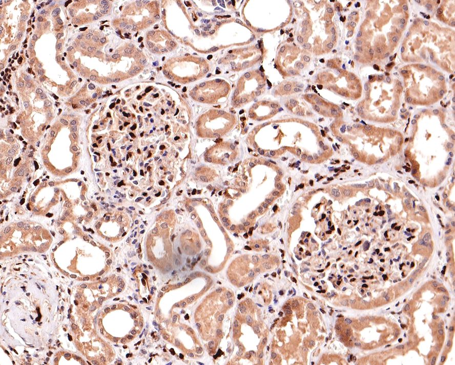 Immunohistochemical analysis of paraffin-embedded human prostate cancer tissue with Rabbit anti-ERG antibody (ET1604-21) at 1/500 dilution.<br />
<br />
The section was pre-treated using heat mediated antigen retrieval with sodium citrate buffer (pH 6.0) for 2 minutes. The tissues were blocked in 1% BSA for 20 minutes at room temperature, washed with ddH2O and PBS, and then probed with the primary antibody (ET1604-21) at 1/100 dilution for 1 hour at room temperature. The detection was performed using an HRP conjugated compact polymer system. DAB was used as the chromogen. Tissues were counterstained with hematoxylin and mounted with DPX.