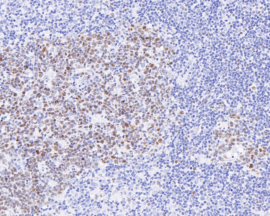 Immunohistochemical analysis of paraffin-embedded human B lymphocytoma tissue with Mouse anti-BCL6 antibody (HA600095) at 1/500 dilution.<br />
<br />
The section was pre-treated using heat mediated antigen retrieval with sodium citrate buffer (pH 6.0) for 2 minutes. The tissues were blocked in 1% BSA for 20 minutes at room temperature, washed with ddH2O and PBS, and then probed with the primary antibody (HA600095) at 1/500 dilution for 1 hour at room temperature. The detection was performed using an HRP conjugated compact polymer system. DAB was used as the chromogen. Tissues were counterstained with hematoxylin and mounted with DPX.