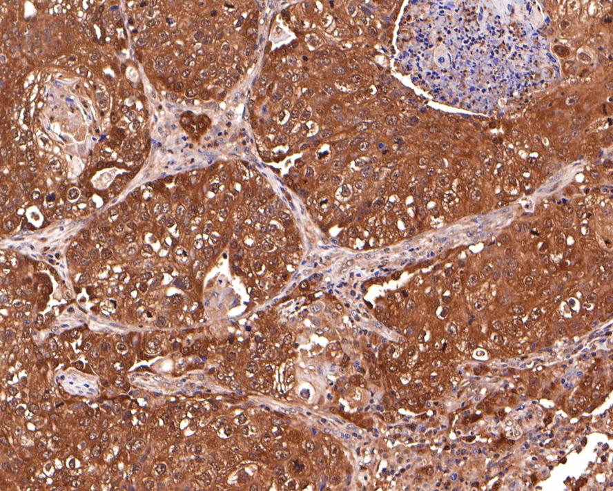 Immunohistochemical analysis of paraffin-embedded human lung squamous carcinoma tissue with Rabbit anti-GST3 antibody (ET7107-71) at 1/500 dilution.<br />
<br />
The section was pre-treated using heat mediated antigen retrieval with Tris-EDTA buffer (pH 9.0) for 20 minutes. The tissues were blocked in 1% BSA for 20 minutes at room temperature, washed with ddH2O and PBS, and then probed with the primary antibody (ET7107-71) at 1/500 dilution for 1 hour at room temperature. The detection was performed using an HRP conjugated compact polymer system. DAB was used as the chromogen. Tissues were counterstained with hematoxylin and mounted with DPX.