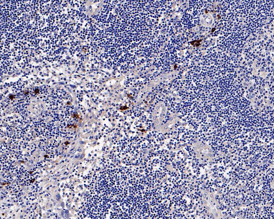 Immunohistochemical analysis of paraffin-embedded human lymph nodes tissue with Rabbit anti-Mast Cell Chymase antibody (ET7107-19) at 1/800 dilution.<br />
<br />
The section was pre-treated using heat mediated antigen retrieval with Tris-EDTA buffer (pH 9.0) for 20 minutes. The tissues were blocked in 1% BSA for 20 minutes at room temperature, washed with ddH2O and PBS, and then probed with the primary antibody (ET7107-19) at 1/800 dilution for 1 hour at room temperature. The detection was performed using an HRP conjugated compact polymer system. DAB was used as the chromogen. Tissues were counterstained with hematoxylin and mounted with DPX.