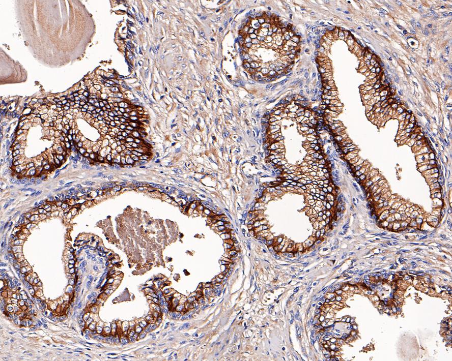 Immunohistochemical analysis of paraffin-embedded human prostate tissue with Rabbit anti-CD46 antibody (ET7107-94) at 1/800 dilution.<br />
<br />
The section was pre-treated using heat mediated antigen retrieval with Tris-EDTA buffer (pH 9.0) for 20 minutes. The tissues were blocked in 1% BSA for 20 minutes at room temperature, washed with ddH2O and PBS, and then probed with the primary antibody (ET7107-94) at 1/800 dilution for 1 hour at room temperature. The detection was performed using an HRP conjugated compact polymer system. DAB was used as the chromogen. Tissues were counterstained with hematoxylin and mounted with DPX.