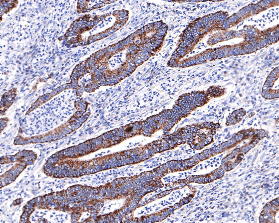 Immunohistochemical analysis of paraffin-embedded human colon carcinoma with Rabbit anti-Emi1 antibody (ET7108-20) at 1/400 dilution.<br />
<br />
The section was pre-treated using heat mediated antigen retrieval with Tris-EDTA buffer (pH 9.0) for 20 minutes. The tissues were blocked in 1% BSA for 20 minutes at room temperature, washed with ddH2O and PBS, and then probed with the primary antibody (ET7108-20) at 1/400 dilution for 1 hour at room temperature. The detection was performed using an HRP conjugated compact polymer system. DAB was used as the chromogen. Tissues were counterstained with hematoxylin and mounted with DPX.