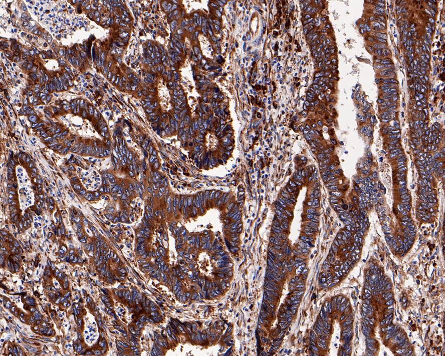 Immunohistochemical analysis of paraffin-embedded human colon carcinoma tissue with Rabbit anti-RPS20 antibody (ET1610-83) at 1/200 dilution.<br />
<br />
The section was pre-treated using heat mediated antigen retrieval with Tris-EDTA buffer (pH 9.0) for 20 minutes. The tissues were blocked in 1% BSA for 20 minutes at room temperature, washed with ddH2O and PBS, and then probed with the primary antibody (ET1610-83) at 1/200 dilution for 1 hour at room temperature. The detection was performed using an HRP conjugated compact polymer system. DAB was used as the chromogen. Tissues were counterstained with hematoxylin and mounted with DPX.