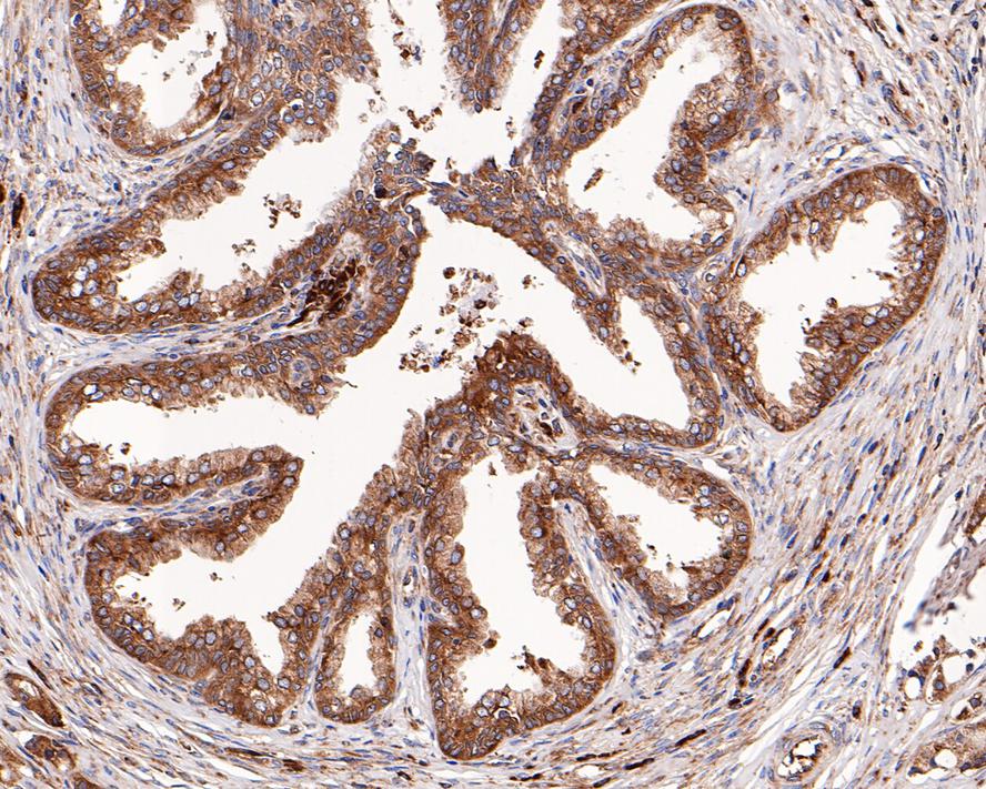 Immunohistochemical analysis of paraffin-embedded human prostate carcinoma tissue with Rabbit anti-RPS20 antibody (ET1610-83) at 1/200 dilution.<br />
<br />
The section was pre-treated using heat mediated antigen retrieval with Tris-EDTA buffer (pH 9.0) for 20 minutes. The tissues were blocked in 1% BSA for 20 minutes at room temperature, washed with ddH2O and PBS, and then probed with the primary antibody (ET1610-83) at 1/200 dilution for 1 hour at room temperature. The detection was performed using an HRP conjugated compact polymer system. DAB was used as the chromogen. Tissues were counterstained with hematoxylin and mounted with DPX.