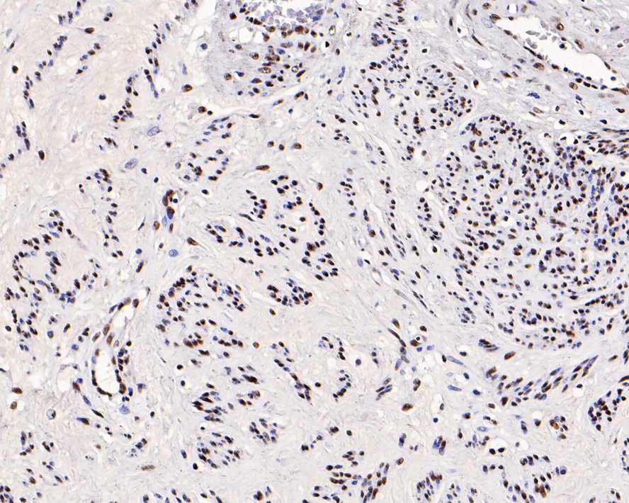 Immunohistochemical analysis of paraffin-embedded human cervix tissue with Rabbit anti-GTPBP4 antibody (ET7109-59) at 1/500 dilution.<br />
<br />
The section was pre-treated using heat mediated antigen retrieval with sodium citrate buffer (pH 6.0) for 2 minutes. The tissues were blocked in 1% BSA for 20 minutes at room temperature, washed with ddH2O and PBS, and then probed with the primary antibody (ET7109-59) at 1/500 dilution for 1 hour at room temperature. The detection was performed using an HRP conjugated compact polymer system. DAB was used as the chromogen. Tissues were counterstained with hematoxylin and mounted with DPX.