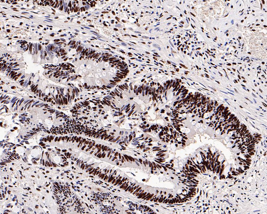 Immunohistochemical analysis of paraffin-embedded human colon carcinoma tissue with Rabbit anti-GTPBP4 antibody (ET7109-59) at 1/500 dilution.<br />
<br />
The section was pre-treated using heat mediated antigen retrieval with sodium citrate buffer (pH 6.0) for 2 minutes. The tissues were blocked in 1% BSA for 20 minutes at room temperature, washed with ddH2O and PBS, and then probed with the primary antibody (ET7109-59) at 1/500 dilution for 1 hour at room temperature. The detection was performed using an HRP conjugated compact polymer system. DAB was used as the chromogen. Tissues were counterstained with hematoxylin and mounted with DPX.
