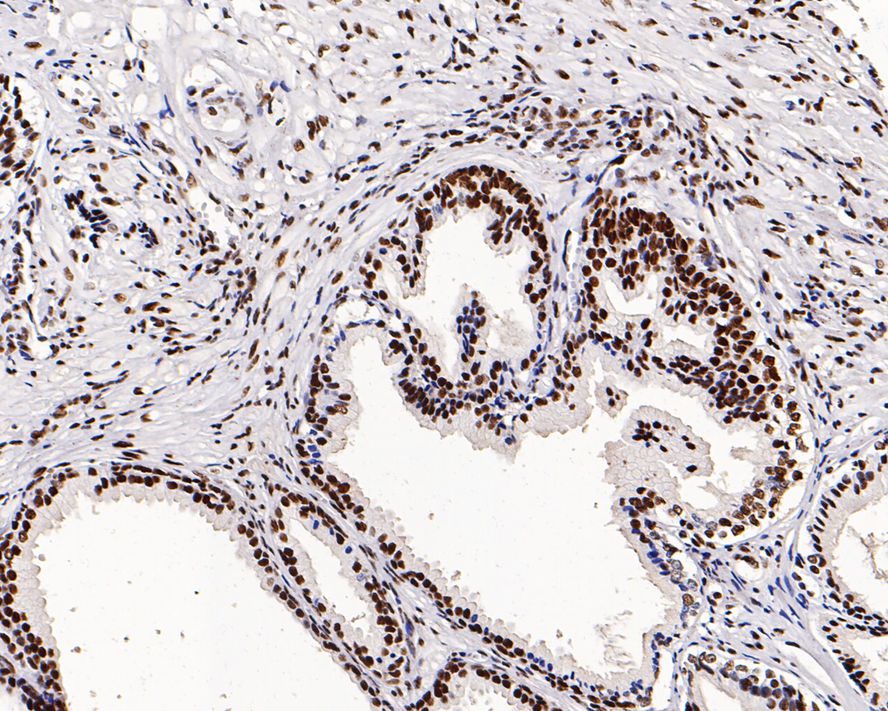 Immunohistochemical analysis of paraffin-embedded human prostate tissue with Rabbit anti-GTPBP4 antibody (ET7109-59) at 1/500 dilution.<br />
<br />
The section was pre-treated using heat mediated antigen retrieval with sodium citrate buffer (pH 6.0) for 2 minutes. The tissues were blocked in 1% BSA for 20 minutes at room temperature, washed with ddH2O and PBS, and then probed with the primary antibody (ET7109-59) at 1/500 dilution for 1 hour at room temperature. The detection was performed using an HRP conjugated compact polymer system. DAB was used as the chromogen. Tissues were counterstained with hematoxylin and mounted with DPX.