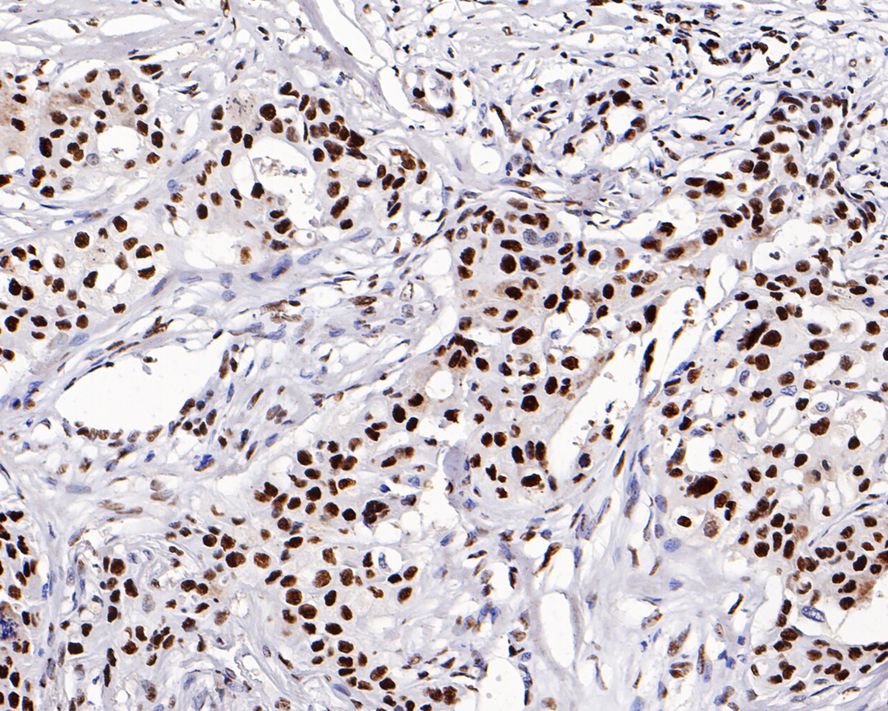 Immunohistochemical analysis of paraffin-embedded human breast carcinoma tissue with Rabbit anti-GTPBP4 antibody (ET7109-59) at 1/500 dilution.<br />
<br />
The section was pre-treated using heat mediated antigen retrieval with sodium citrate buffer (pH 6.0) for 2 minutes. The tissues were blocked in 1% BSA for 20 minutes at room temperature, washed with ddH2O and PBS, and then probed with the primary antibody (ET7109-59) at 1/500 dilution for 1 hour at room temperature. The detection was performed using an HRP conjugated compact polymer system. DAB was used as the chromogen. Tissues were counterstained with hematoxylin and mounted with DPX.