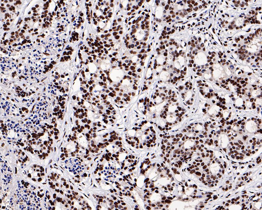 Immunohistochemical analysis of paraffin-embedded human stomach carcinoma tissue with Rabbit anti-GTPBP4 antibody (ET7109-59) at 1/500 dilution.<br />
<br />
The section was pre-treated using heat mediated antigen retrieval with sodium citrate buffer (pH 6.0) for 2 minutes. The tissues were blocked in 1% BSA for 20 minutes at room temperature, washed with ddH2O and PBS, and then probed with the primary antibody (ET7109-59) at 1/500 dilution for 1 hour at room temperature. The detection was performed using an HRP conjugated compact polymer system. DAB was used as the chromogen. Tissues were counterstained with hematoxylin and mounted with DPX.