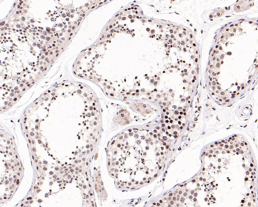 Immunohistochemical analysis of paraffin-embedded human colon tissue with Rabbit anti-Phospho-SIRT1 (S47) antibody (ET1611-31) at 1/200 dilution.<br />
<br />
The section was pre-treated using heat mediated antigen retrieval with sodium citrate buffer (pH 6.0) for 2 minutes. The tissues were blocked in 1% BSA for 20 minutes at room temperature, washed with ddH2O and PBS, and then probed with the primary antibody (ET1611-31) at 1/200 dilution for 1 hour at room temperature. The detection was performed using an HRP conjugated compact polymer system. DAB was used as the chromogen. Tissues were counterstained with hematoxylin and mounted with DPX.