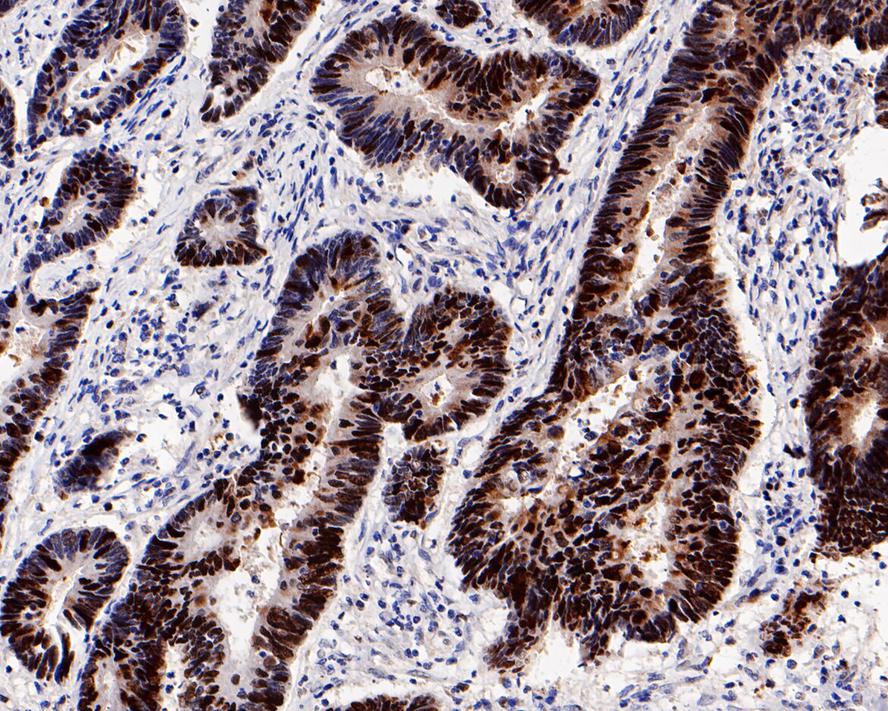 Immunohistochemical analysis of paraffin-embedded human colon carcinoma tissue with Rabbit anti-Rb antibody (ET1607-9) at 1/800 dilution.<br />
<br />
The section was pre-treated using heat mediated antigen retrieval with sodium citrate buffer (pH 6.0) for 2 minutes. The tissues were blocked in 1% BSA for 20 minutes at room temperature, washed with ddH2O and PBS, and then probed with the primary antibody (ET1607-9) at 1/800 dilution for 1 hour at room temperature. The detection was performed using an HRP conjugated compact polymer system. DAB was used as the chromogen. Tissues were counterstained with hematoxylin and mounted with DPX.