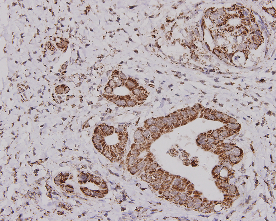 Immunohistochemical analysis of paraffin-embedded human gastric carcinoma tissue using anti- ALDH2 mouse mAb.
