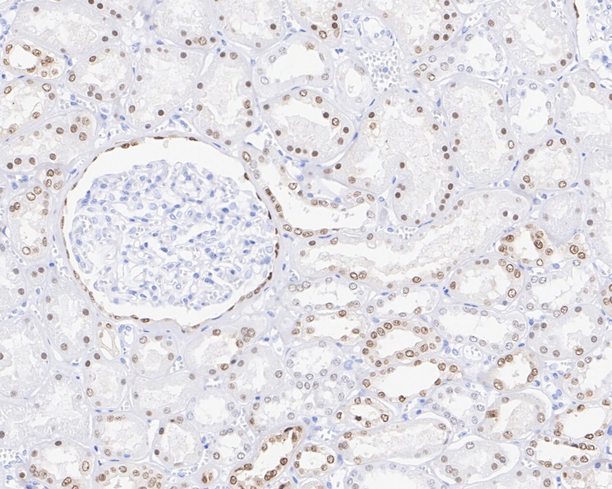 Immunohistochemical analysis of paraffin-embedded human thyroid carcinoma tissue with Rabbit anti-PAX8 antibody (HA720112) at 1/5,000 dilution.<br />
<br />
The section was pre-treated using heat mediated antigen retrieval with sodium citrate buffer (pH 6.0) for 2 minutes. The tissues were blocked in 1% BSA for 20 minutes at room temperature, washed with ddH2O and PBS, and then probed with the primary antibody (HA720112) at 1/5,000 dilution for 1 hour at room temperature. The detection was performed using an HRP conjugated compact polymer system. DAB was used as the chromogen. Tissues were counterstained with hematoxylin and mounted with DPX.