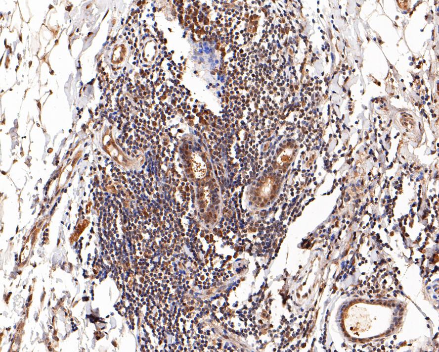 Immunohistochemical analysis of paraffin-embedded human breast carcinoma tissue with Mouse anti-Glucocorticoid Receptor alpha antibody (EM1701-66) at 1/200 dilution.<br />
<br />
The section was pre-treated using heat mediated antigen retrieval with sodium citrate buffer (pH 6.0) for 2 minutes. The tissues were blocked in 1% BSA for 20 minutes at room temperature, washed with ddH2O and PBS, and then probed with the primary antibody (EM1701-66) at 1/200 dilution for 1 hour at room temperature. The detection was performed using an HRP conjugated compact polymer system. DAB was used as the chromogen. Tissues were counterstained with hematoxylin and mounted with DPX.