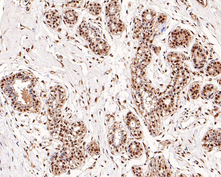 Immunohistochemical analysis of paraffin-embedded human breast tissue with Mouse anti-NFIB NF1B2 antibody (EM1701-67) at 1/1,000 dilution.<br />
<br />
The section was pre-treated using heat mediated antigen retrieval with sodium citrate buffer (pH 6.0) for 2 minutes. The tissues were blocked in 1% BSA for 20 minutes at room temperature, washed with ddH2O and PBS, and then probed with the primary antibody (EM1701-67) at 1/1,000 dilution for 1 hour at room temperature. The detection was performed using an HRP conjugated compact polymer system. DAB was used as the chromogen. Tissues were counterstained with hematoxylin and mounted with DPX.