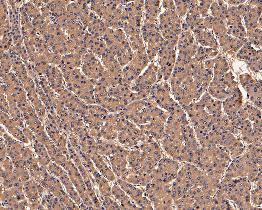 Immunohistochemical analysis of paraffin-embedded human liver carcinoma tissue with Mouse anti-PRDX2 antibody (EM1701-71) at 1/200 dilution.<br />
<br />
The section was pre-treated using heat mediated antigen retrieval with Tris-EDTA buffer (pH 9.0) for 20 minutes. The tissues were blocked in 1% BSA for 20 minutes at room temperature, washed with ddH2O and PBS, and then probed with the primary antibody (EM1701-71) at 1/200 dilution for 1 hour at room temperature. The detection was performed using an HRP conjugated compact polymer system. DAB was used as the chromogen. Tissues were counterstained with hematoxylin and mounted with DPX.