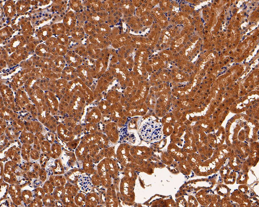 Immunohistochemical analysis of paraffin-embedded human colon carcinoma tissue with Mouse anti-PRDX2 antibody (EM1701-72) at 1/200 dilution.<br />
<br />
The section was pre-treated using heat mediated antigen retrieval with Tris-EDTA buffer (pH 9.0) for 20 minutes. The tissues were blocked in 1% BSA for 20 minutes at room temperature, washed with ddH2O and PBS, and then probed with the primary antibody (EM1701-72) at 1/200 dilution for 1 hour at room temperature. The detection was performed using an HRP conjugated compact polymer system. DAB was used as the chromogen. Tissues were counterstained with hematoxylin and mounted with DPX.
