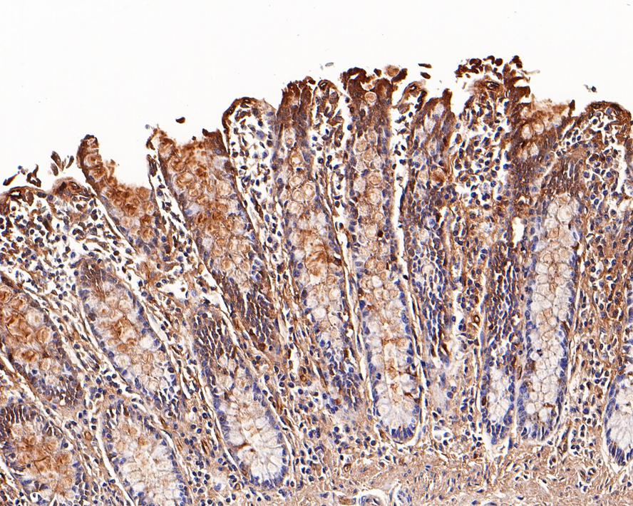 Immunohistochemical analysis of paraffin-embedded human thyroid carcinoma tissue with Rabbit anti-Galectin 3 antibody (ET1702-48) at 1/200 dilution.<br />
<br />
The section was pre-treated using heat mediated antigen retrieval with sodium citrate buffer (pH 6.0) for 2 minutes. The tissues were blocked in 1% BSA for 20 minutes at room temperature, washed with ddH2O and PBS, and then probed with the primary antibody (ET1702-48) at 1/200 dilution for 1 hour at room temperature. The detection was performed using an HRP conjugated compact polymer system. DAB was used as the chromogen. Tissues were counterstained with hematoxylin and mounted with DPX.