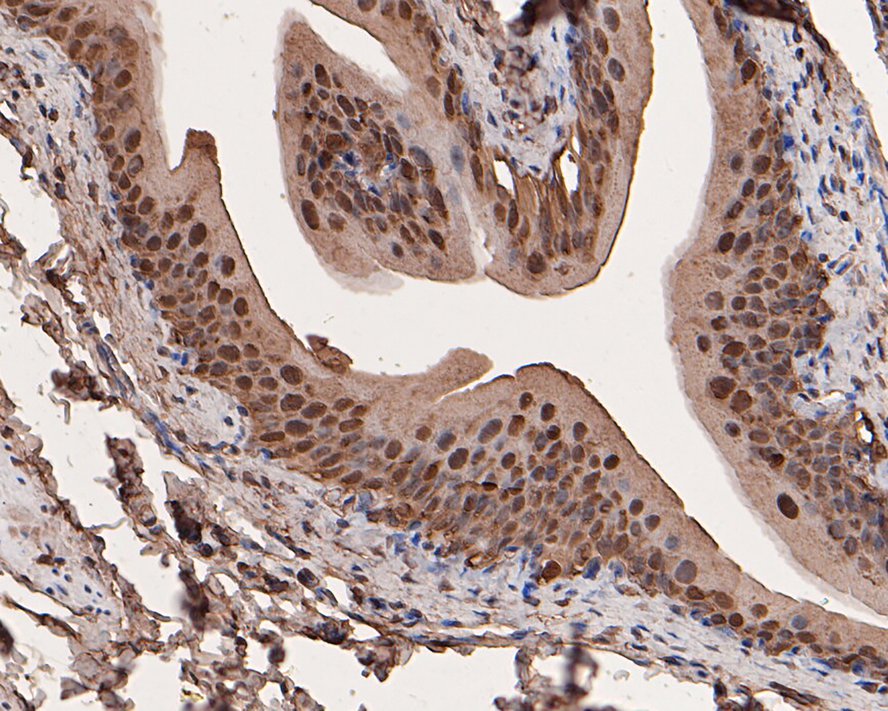 Immunohistochemical analysis of paraffin-embedded human colon tissue with Rabbit anti-Galectin 3 antibody (ET1702-48) at 1/1,000 dilution.<br />
<br />
The section was pre-treated using heat mediated antigen retrieval with sodium citrate buffer (pH 6.0) for 2 minutes. The tissues were blocked in 1% BSA for 20 minutes at room temperature, washed with ddH2O and PBS, and then probed with the primary antibody (ET1702-48) at 1/1,000 dilution for 1 hour at room temperature. The detection was performed using an HRP conjugated compact polymer system. DAB was used as the chromogen. Tissues were counterstained with hematoxylin and mounted with DPX.