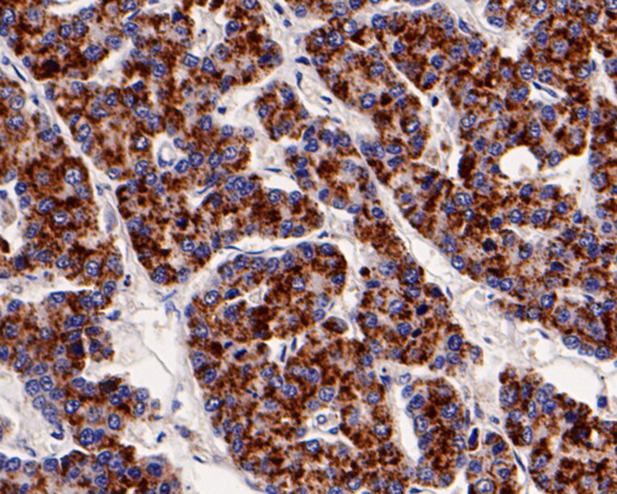 Immunohistochemical analysis of paraffin-embedded human liver cancer tissue with Mouse anti-Catalase antibody (M1501-6) at 1/400 dilution.<br />
<br />
The section was pre-treated using heat mediated antigen retrieval with Tris-EDTA buffer (pH 9.0) for 20 minutes. The tissues were blocked in 1% BSA for 20 minutes at room temperature, washed with ddH2O and PBS, and then probed with the primary antibody (M1501-6) at 1/400 dilution for 1 hour at room temperature. The detection was performed using an HRP conjugated compact polymer system. DAB was used as the chromogen. Tissues were counterstained with hematoxylin and mounted with DPX.