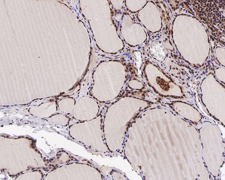 Immunohistochemical analysis of paraffin-embedded human thyroid tissue with Mouse anti-Cyclin E2 antibody (M0407-15) at 1/200 dilution.<br />
<br />
The section was pre-treated using heat mediated antigen retrieval with sodium citrate buffer (pH 6.0) for 2 minutes. The tissues were blocked in 1% BSA for 20 minutes at room temperature, washed with ddH2O and PBS, and then probed with the primary antibody (M0407-15) at 1/200 dilution for 1 hour at room temperature. The detection was performed using an HRP conjugated compact polymer system. DAB was used as the chromogen. Tissues were counterstained with hematoxylin and mounted with DPX.