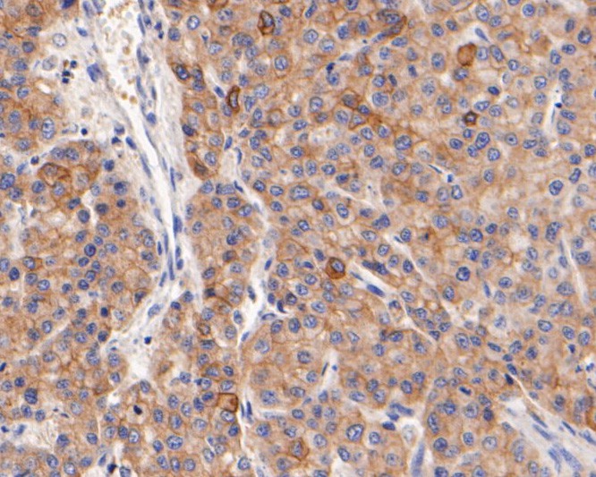 Immunohistochemical analysis of paraffin-embedded human liver carcinoma tissue with Rabbit anti-Cytokeratin 18 antibody (0407-1) at 1/400 dilution.<br />
<br />
The section was pre-treated using heat mediated antigen retrieval with Tris-EDTA buffer (pH 9.0) for 20 minutes. The tissues were blocked in 1% BSA for 20 minutes at room temperature, washed with ddH2O and PBS, and then probed with the primary antibody (0407-1) at 1/400 dilution for 1 hour at room temperature. The detection was performed using an HRP conjugated compact polymer system. DAB was used as the chromogen. Tissues were counterstained with hematoxylin and mounted with DPX.